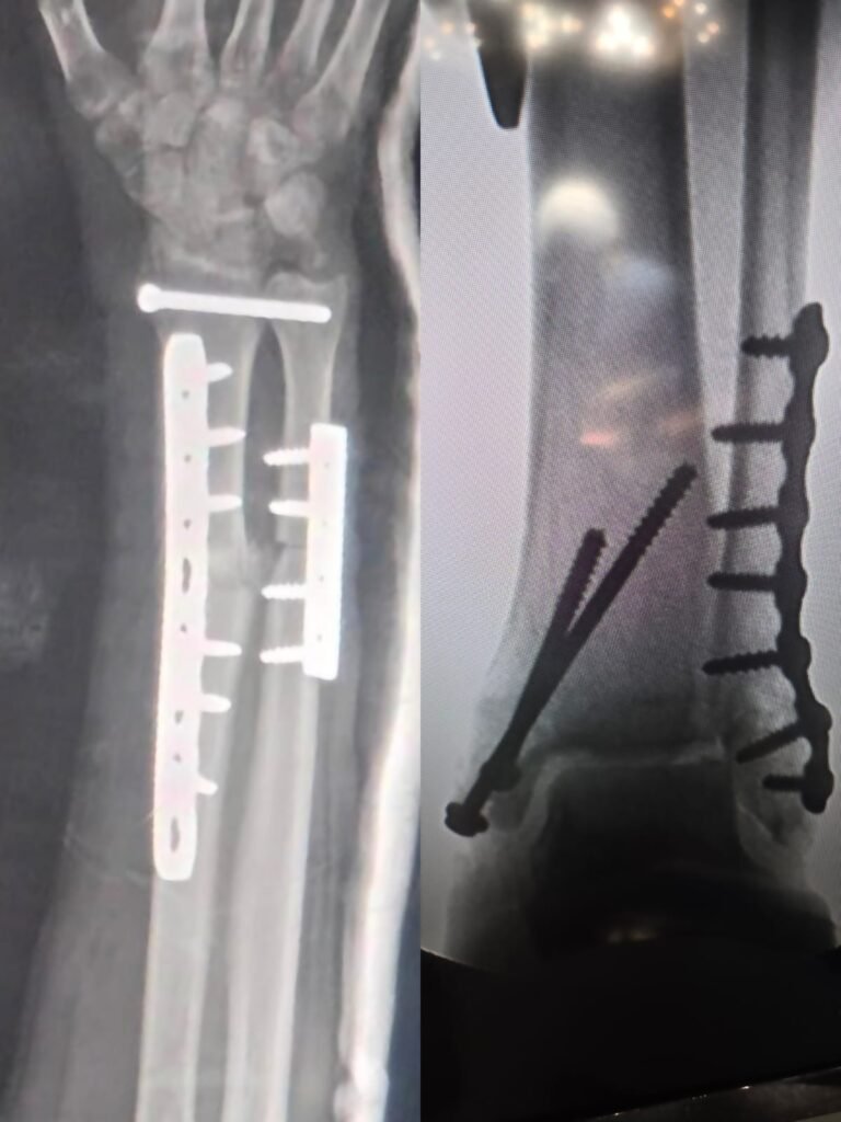 Old Galeazzi Fracture Fixation And Bi-malleolus fraxcture Fixation