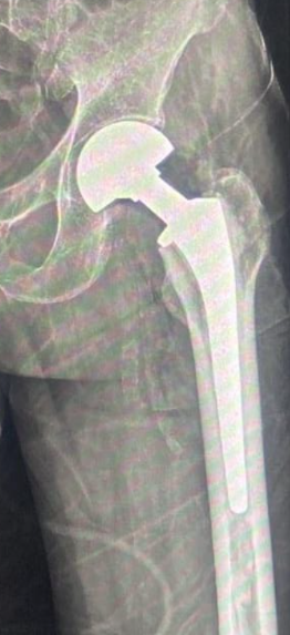 Hip Hemi-arthoplasty